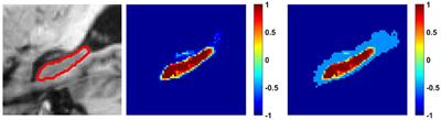 Integrating Semi-supervised and Supervised Learning Methods for Label Fusion in Multi-Atlas Based Image Segmentation